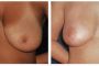 001-breast-lift